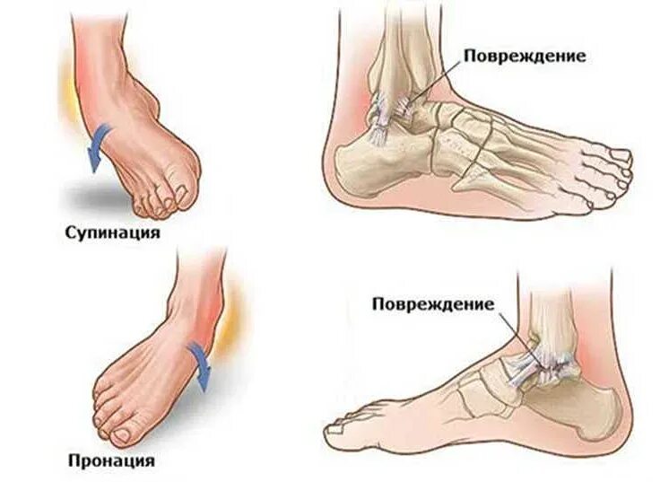 Как выглядит растяжение ноги. Супинация и пронация голеностопного сустава. механизмы повреждения голеностопного сустава. надрыв связок голеностопа симптомы. растяжение сухожилия голеностопного сустава.