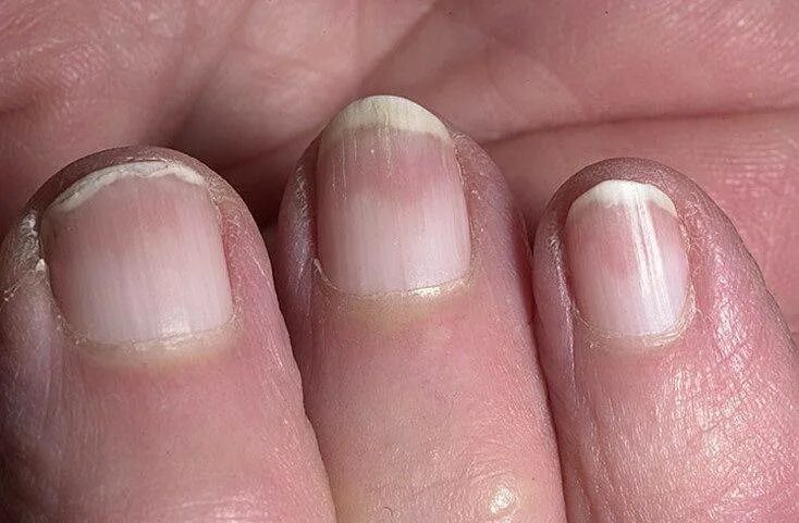 Что означают полосы на ногтях. Ониходистрофия - онихолизис..