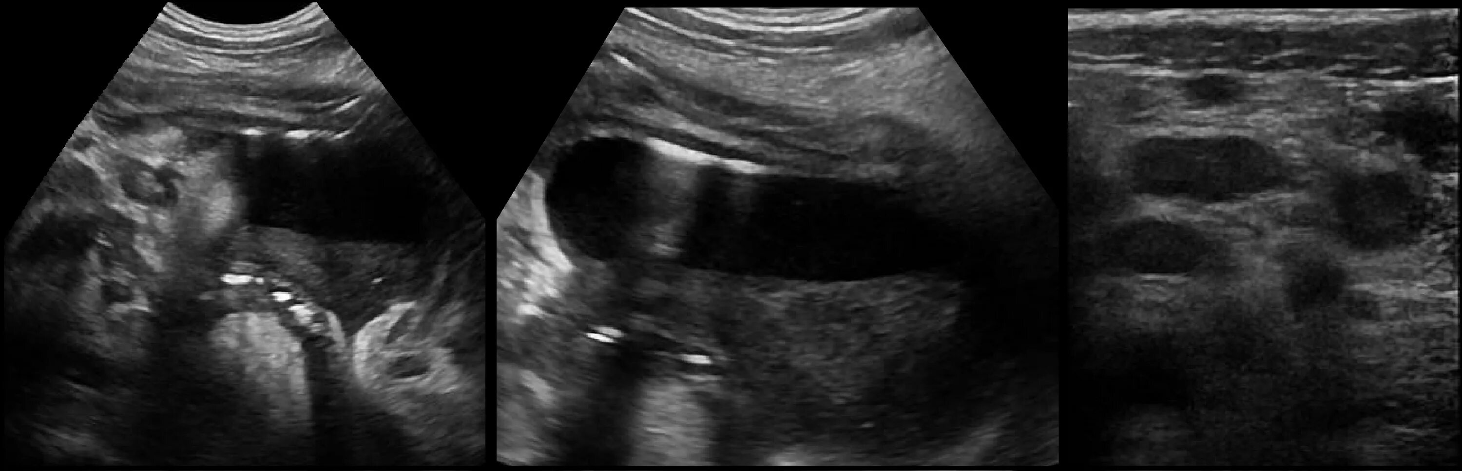 Узи аппендикса. Симптомы острого аппендицита узи. Узи аппендикса. Узи аппендикса. Воспаленный аппендикс на узи.