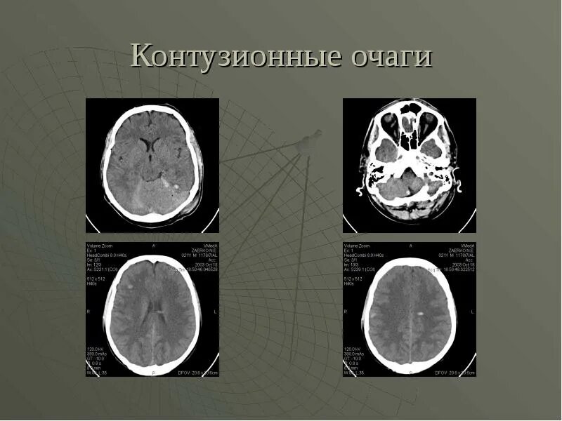 Остеобластические метастазы в костях на кт. Деструктивное воспаление. Деструктивный очаг. Контузионные очаги на кт. Деструктивная функция.