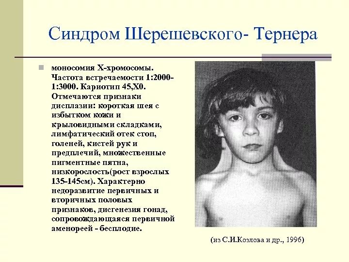 Синдром тернера мкб 10. Синдром шерешевского-тернера (моносомия х-хромосомы). синдром шерешевского тернера мутация. тип мутации шерешевского тернера. шерешевского тернера синдром лимфатический отек стоп.
