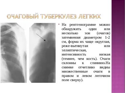 Активность очагового туберкулеза