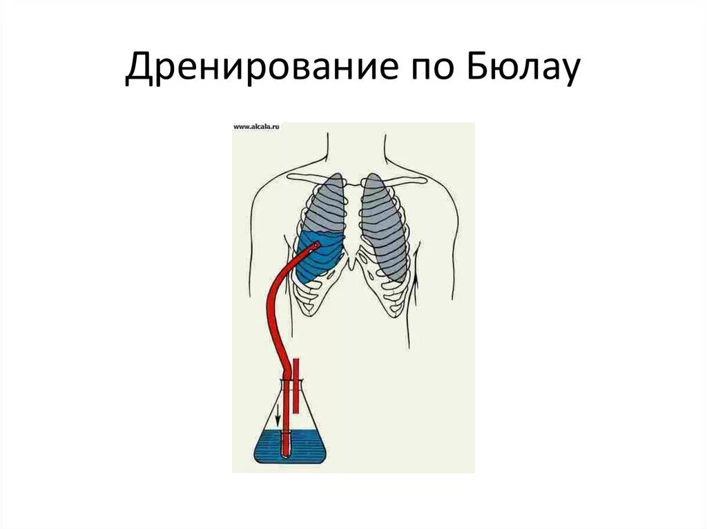 Лечение плевральной полости. Дренирование полости по бюл. Дренирование по Бюлау. Техника Бюлау дренирование. Дренированиетпо Бклау.