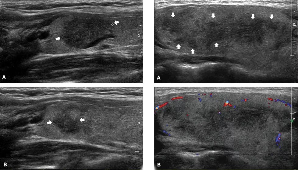 Диффузно узловая гиперплазия железы. Острый тиреоидит щитовидной железы УЗИ. Подострый тиреоидит на УЗИ. Тиреоидит Хашимото УЗИ. Острый тиреоидит УЗИ картина.