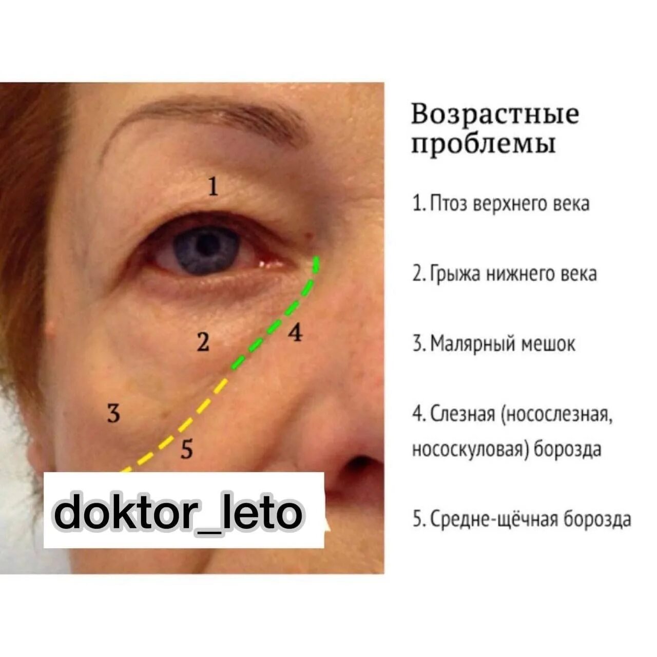 Малярный мешок слезная борозда коррекция. Анатомия носослезной борозды разметка. Малярные мешки анатомия. Что значит припухлость