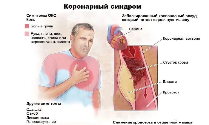 Коронарные осложнения. Клинические симптомы Окс. Острый коронарный синдром причины патогенез. Синдром острой коронарной недостаточности патогенез. Острый коронарный синдром клиническая картина.