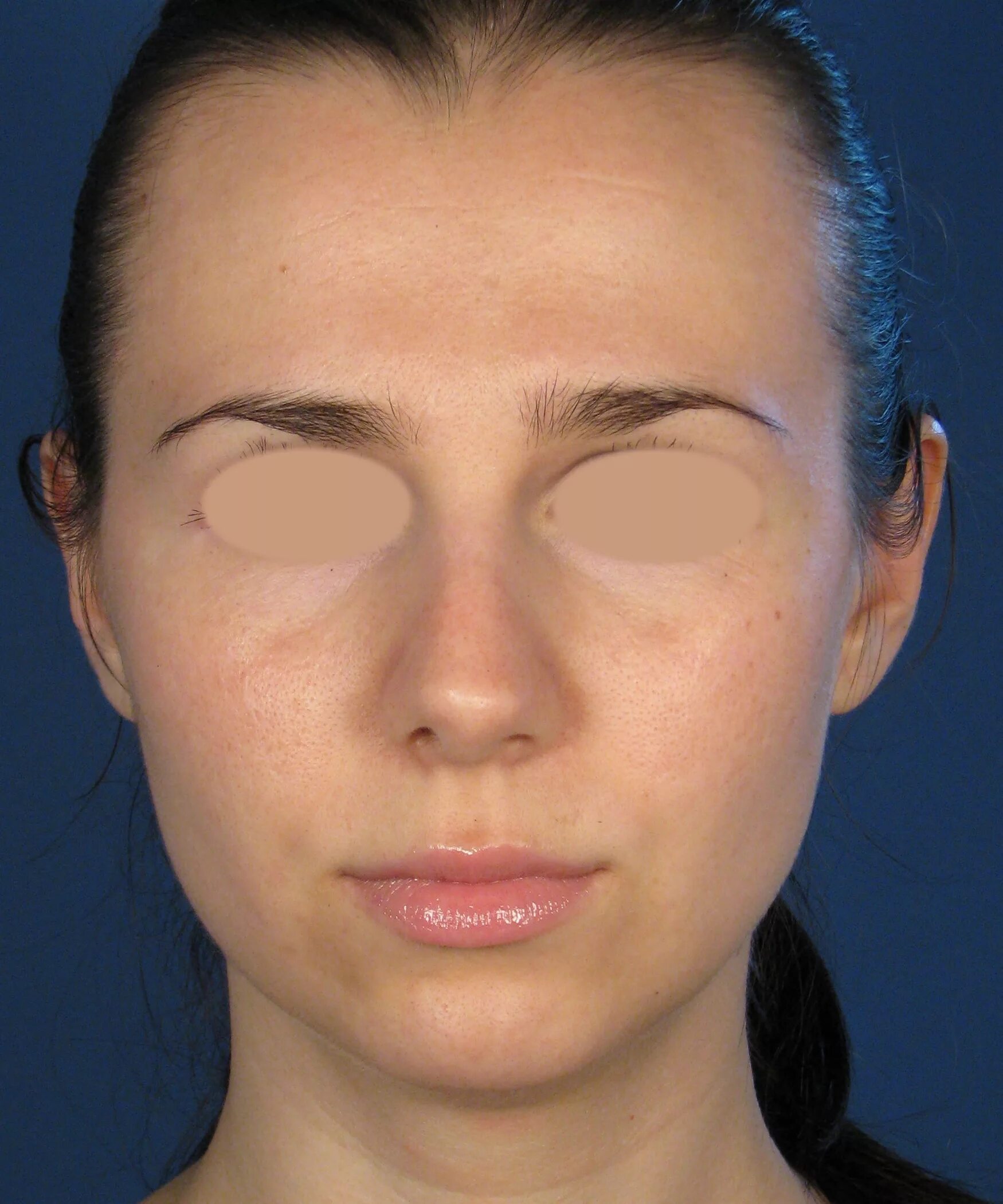 Низкая переносица. Как выглядит переносица. Нос с высокой переносицей. Острый нос. Анатомия носа.