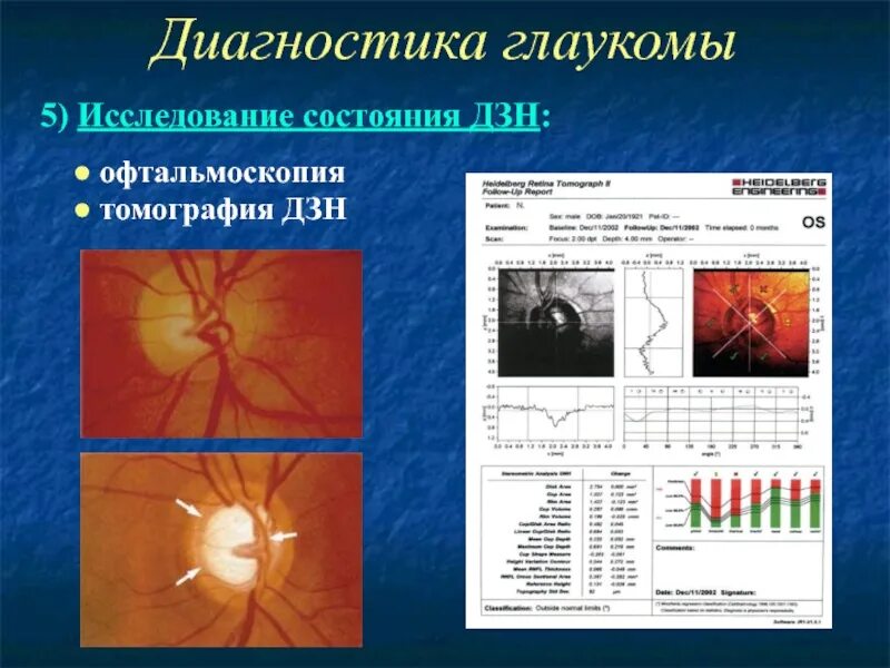 Зрительный нерв при глаукоме. Офтальмоскопия диска зрительного нерва. Метод исследования диска зрительного нерва. Диагностика глаукомы. Исследования при глаукоме.