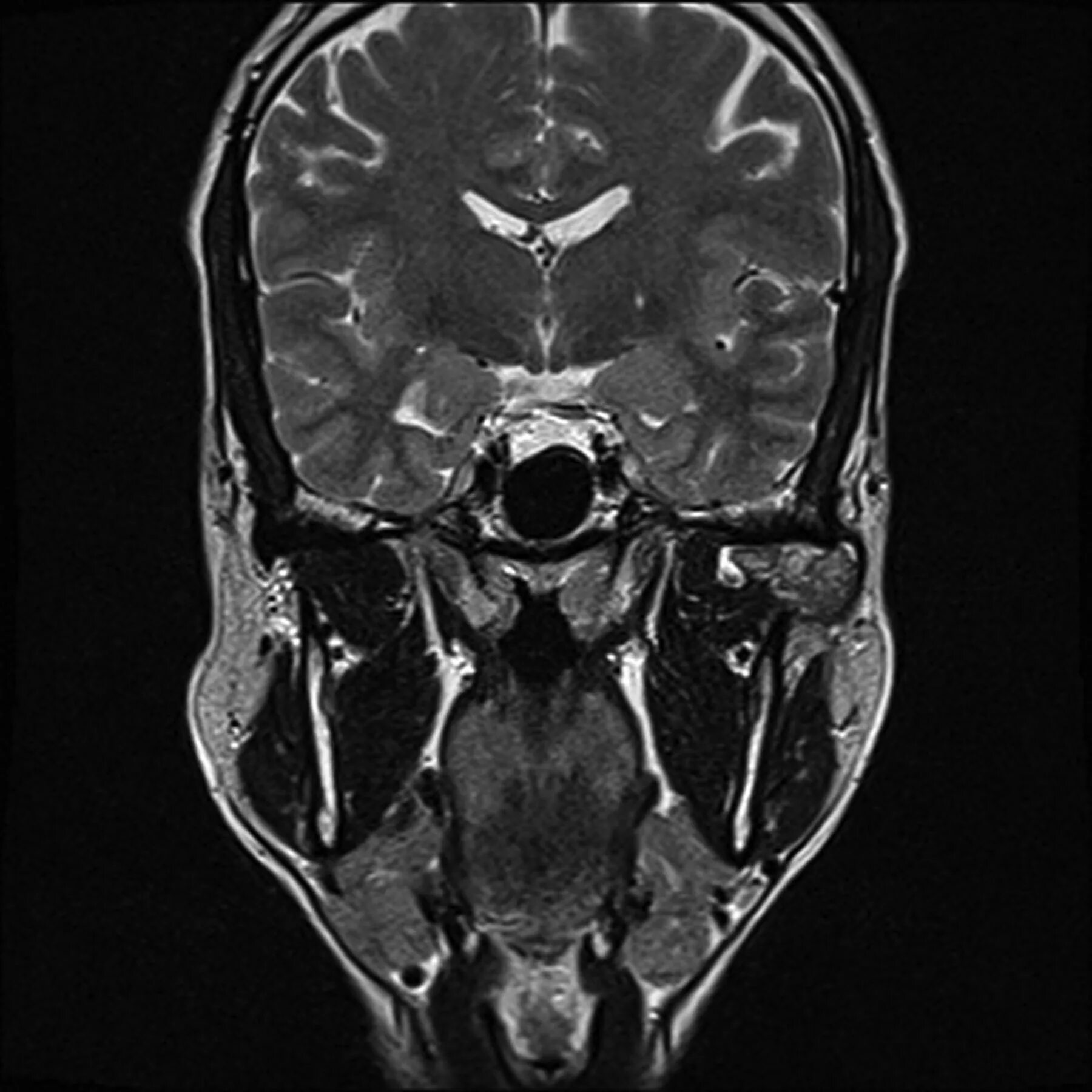 Болезнь шлаттера коленного сустава мрт. Артрит коленного сустава мрт. Joint mri. Болезнь шлаттера коленного сустава мрт. Joint mri.