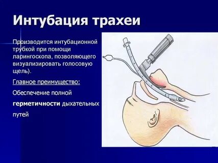 Интубирование что это такое простыми словами