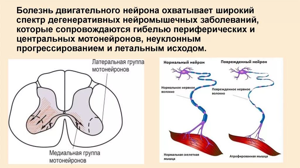 Поражение двигательного нерва. БДН болезнь двигательного нейрона. Периферический двигательный Нейрон неврология. Симптомы поражения центрального мотонейрона. Болезнь двигательного мотонейрона (бас).