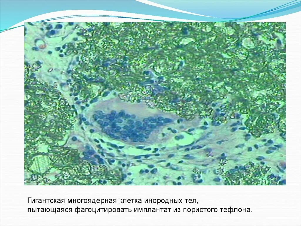 Инородные тела верхних дыхательных путей. Инородные тела пищевода. Инородное тело в пищеводе симптомы. Типы инородных тел. Инородное дело в дыхательных путях.