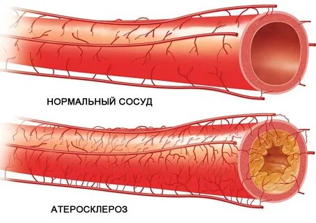 Атеросклероз глаза