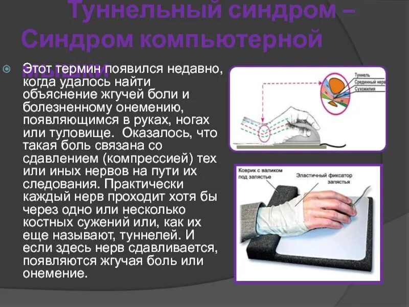 Туннельный синдром электромиография. Синдром компьютерной мыши. Туннельный синдром (синдром запястного канала). Синдром «компьютерной мыши» (туннельный синдром. Туннельный синдром после операции