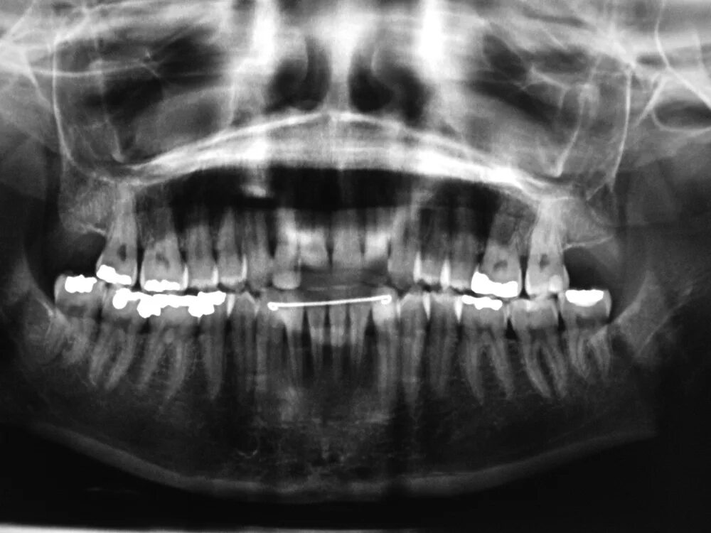 Можно ли мрт с ретейнерами. Томограмма с имплантами. Мрт с зубными имплантами. Металлические имплантаты мрт.
