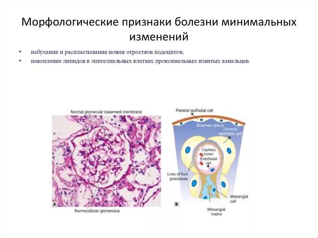 Морфологические изменения болезни