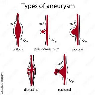 Aneurysm перевод