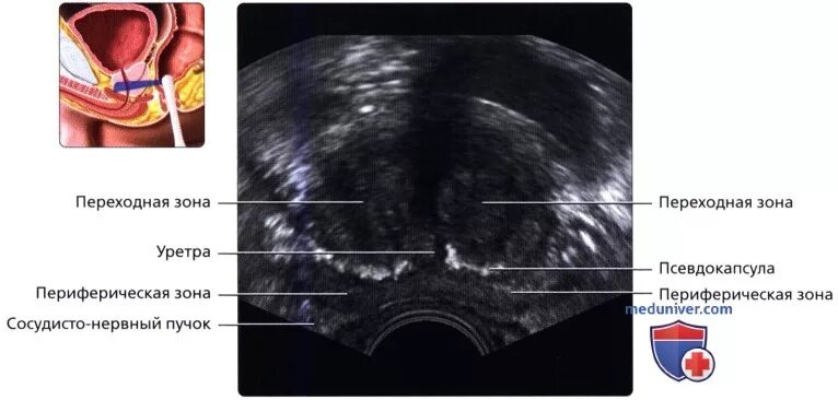 УЗИ анатомия предстательной железы трансректально. Петрификаты предстательной железы что это. Зональная анатомия предстательной железы УЗИ. Гиперплазия предстательной железы УЗИ. Показатели предстательной железы