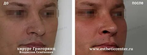 Немеет кончик носа причина