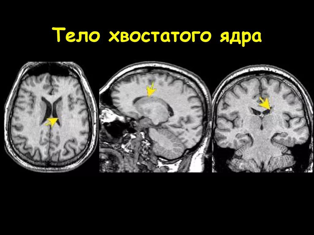 Хвостатое ядро мозга. Хвостатое ядро мозга кт. Хвостатое ядро мрт. Хвостатое тело мозг. Полосатое тело на мрт.