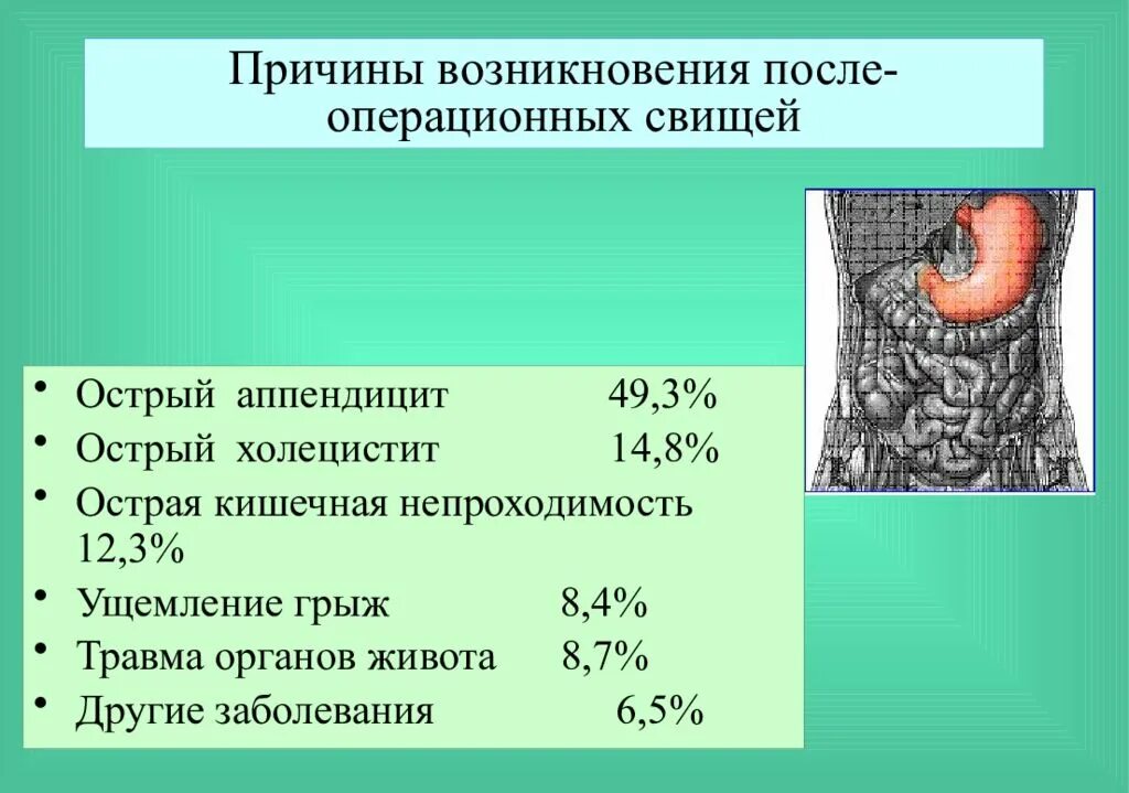 Свищ причины возникновения. Предпосылки аппендицита. Кишечные свищи причины возникновения. Причины острого аппендицита