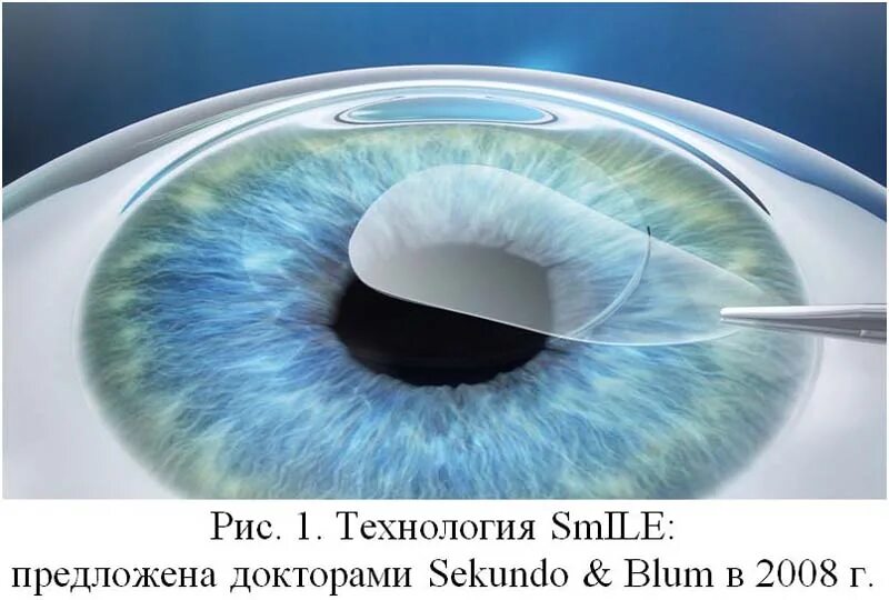 Фемто ласик. Лазерная коррекция зрения методом фрк. Коррекция зрения фемто ласик. Фемто ласик. Эксимер-лазерная коррекция зрения.