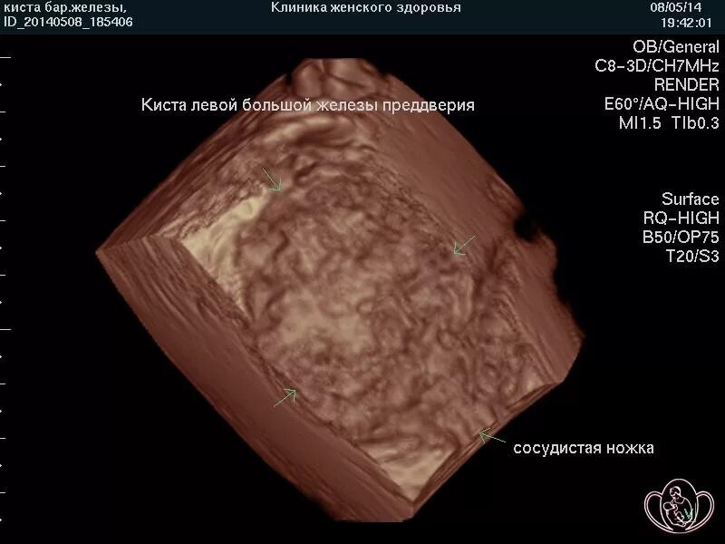 Бартолиновая железа где находится