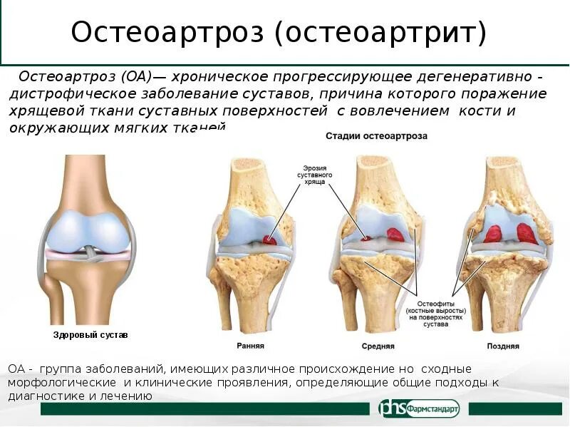 Деформирующий остеоартроз поражение суставов. Остеоартрит (артроз, дегенеративные заболевания суставов). Деформирующий артроз коленного сустава классификация. Гонартроз коленного сустава патогенез. Изменение формы сустава