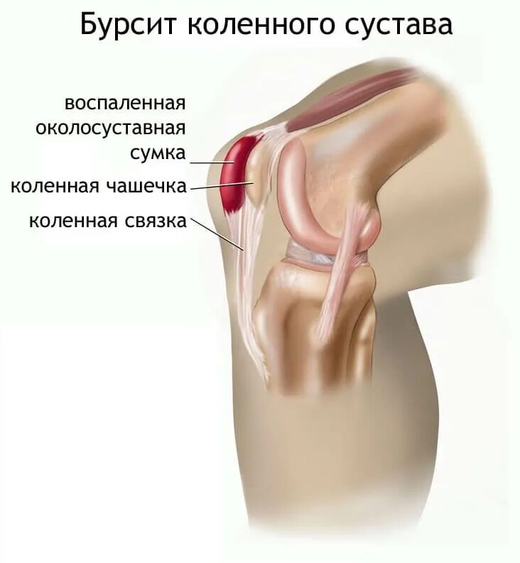 Ноющая боль в коленном. Супрапателлярный бурсит коленного сустава что такое. Супрапателлярный сумка коленного сустава. Бурсит коленного сустава симптомы. Боль в коленном суставе бурсит.