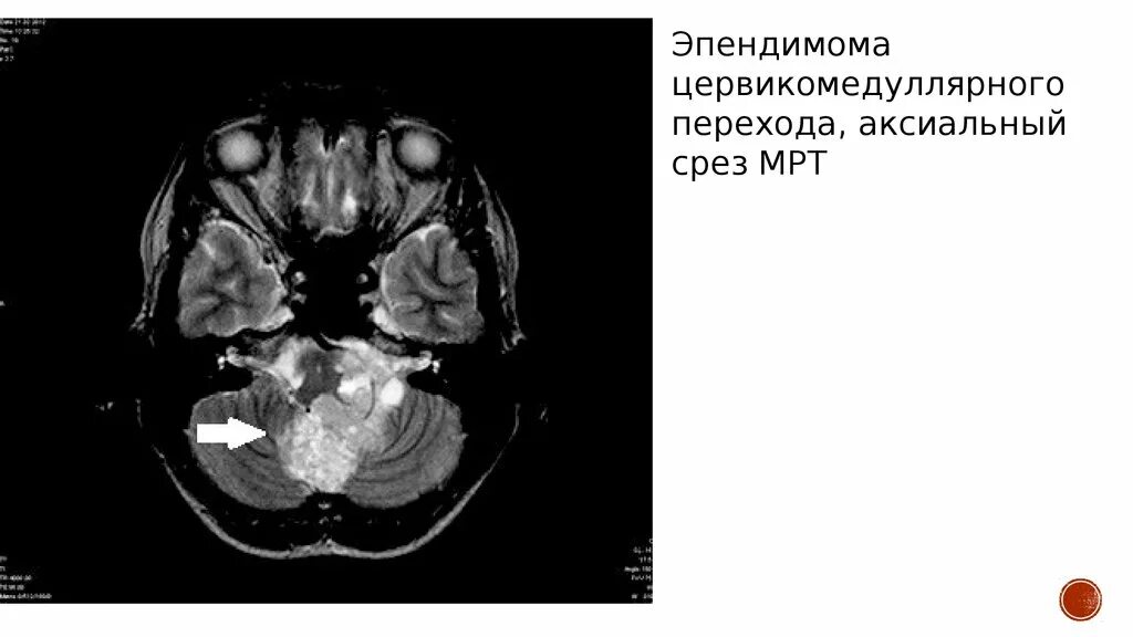 Эпендимома 4 желудочка кт. Эпендимома 4 желудочка мрт. Объемное образование 4 желудочка головного мозга. Эпендимома 4 желудочка головного мозга. Эпендимома 4 желудочка.
