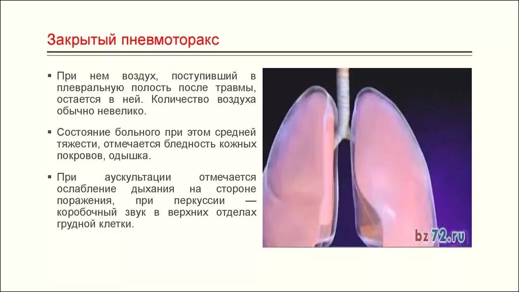 Закрытый пневмоторакс. Pfrhsnsqпневмоторакс. Закрытого пневмоторакса. Закрытый пневмоторакс причины.