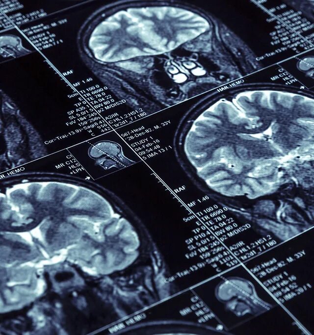 Болезнь паркинсона на мрт головного мозга. Болезни выявляемые мрт. Мрт мозга при деменции. Рассеянный склероз на мрт головного мозга. Мрт больного шизофренией.