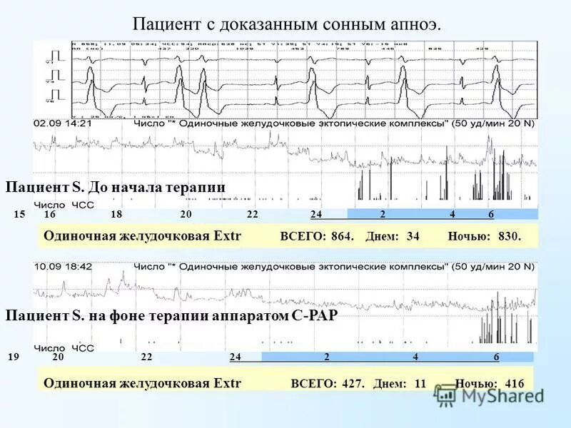 Сонное апноэ. Синдром обструктивного апноэ. Синдром ночного апноэ. Синдром апноэ во сне.