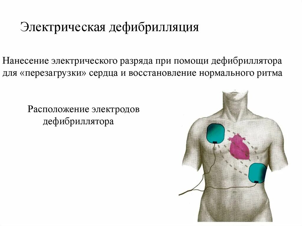 Дефибриллятор проведение дефибрилляции