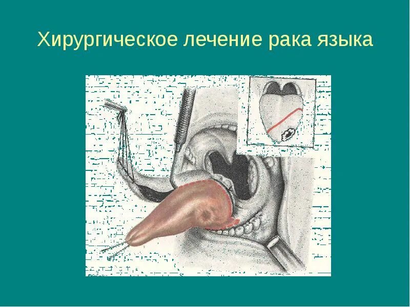 Рак языка реальные фото как выглядит Онкозаболевания Краевая клиническая больница