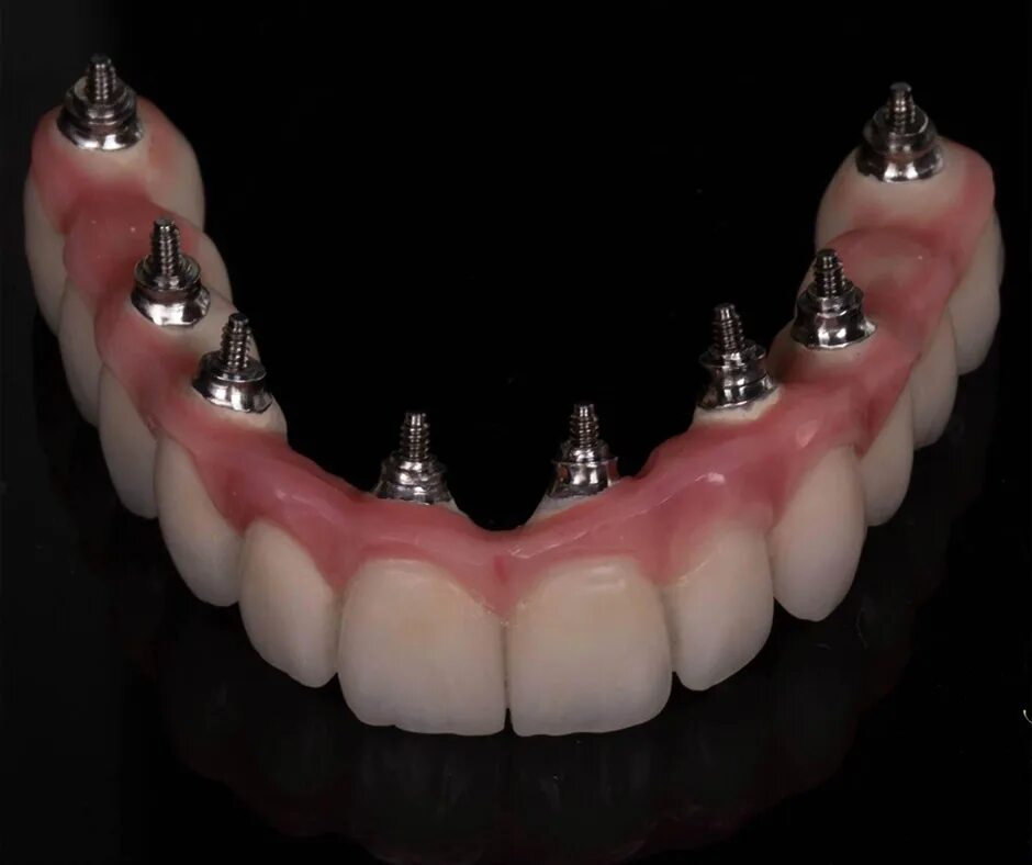 Несъемные зубные протезы. Несъёмный мостовидный протез челюсти. Не сьенмые зубные протезы. Не съёмный протез зуба.