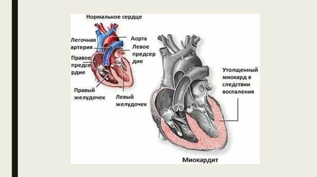 Миокардит левого желудочка. Миокард левого желудочка утолщен. Правое предсердие аорта левый желудочек легкие левое