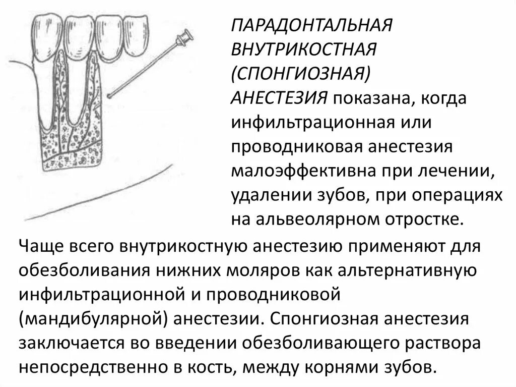 Анестезия полости рта. Внутрикостная анестезия в стоматологии методика. Инфильтрационная и проводниковая анестезия. Местная инфильтрационная анестезия в стоматологии. Внутрикостная (спонгиозная) анестезия в стоматологии.