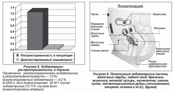 Эндометриоз распространенность. Эндометриоз статистика заболевания. Эндометриоз заболеваемость. Локализация эндометриоза. Анализы при эндометриозе