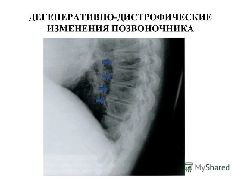 Умеренные дистрофические изменения позвоночника. Дегенеративно-дистрофические изменения позвоночника что это. Дегенеративно дидистрофические изменения. Дегенеративнодистофические изменения.. Дегенеративно дистроыическип из.