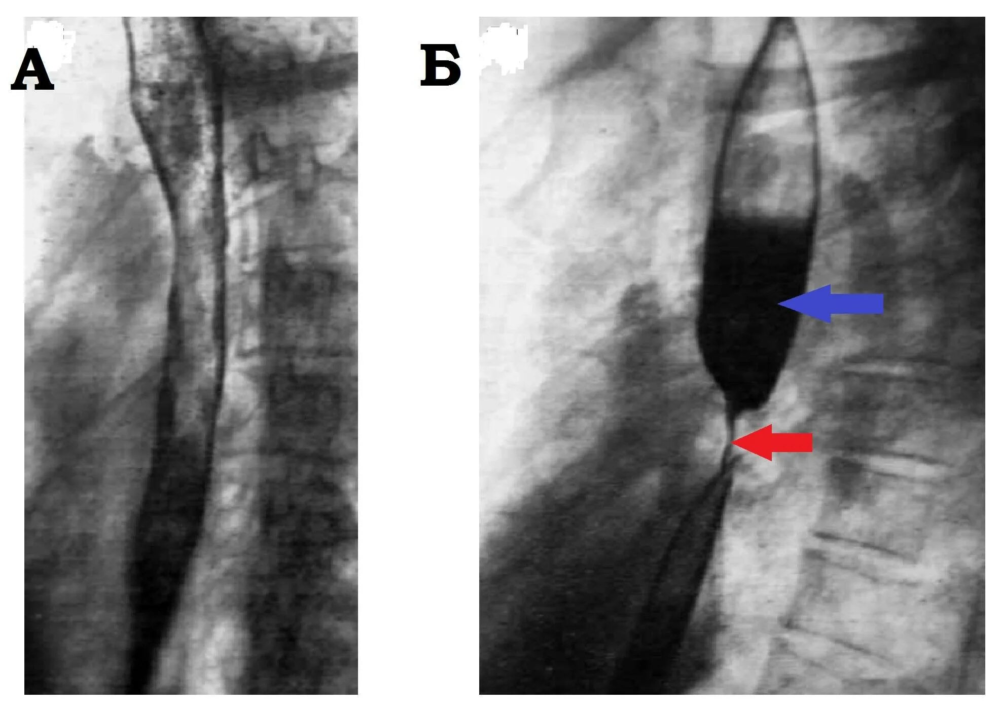 Сужение пищевода симптомы. Врожденный стеноз пищевода рентген. Пептическая стриктура пищевода рентген. Стриктура пищевода и стеноз. Рубцовый стеноз пищевода рентген.