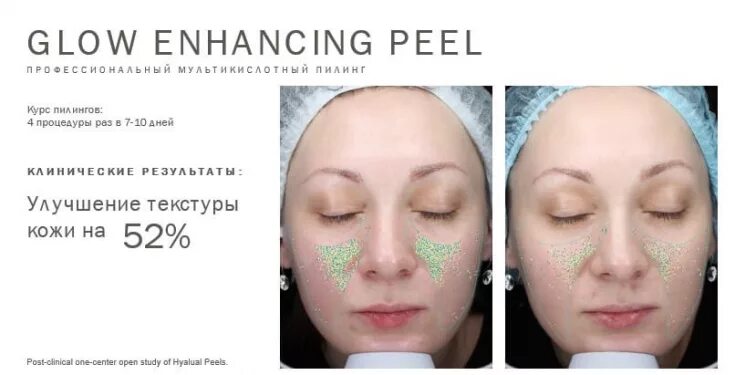 Glow пилинг. Glow peel пилинг мартинекс. glow peel мультикислотный пилинг. hyalual peel пилинг.