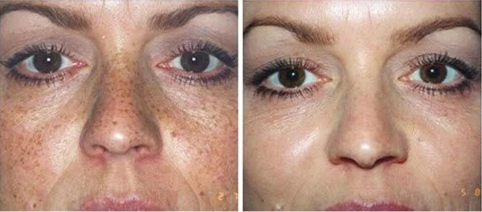 лазерное удаление пигментных пятен отзывы