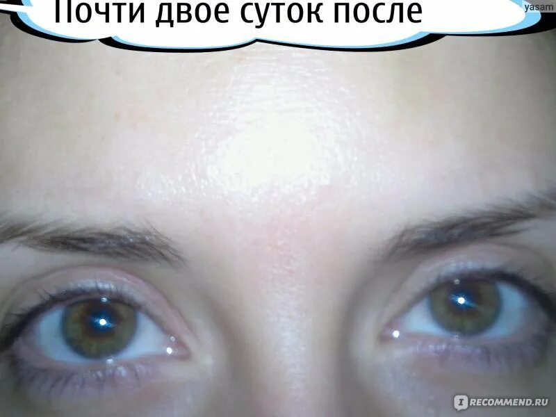 Опустились глаза после ботокса. Опущение бровей после ботокса. опущение бровей после ботокса фото. после ботокса опустились веки фото. птоз век после ботокса фото.