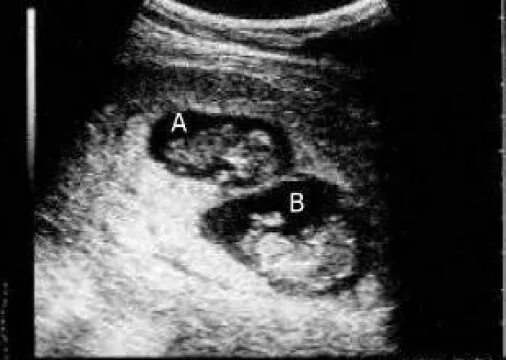 УЗИ беременности двайня 15 недель. УЗИ 10 недель беременности двойня. УЗИ 8 недель беременности двойня. Двойня 7 недель