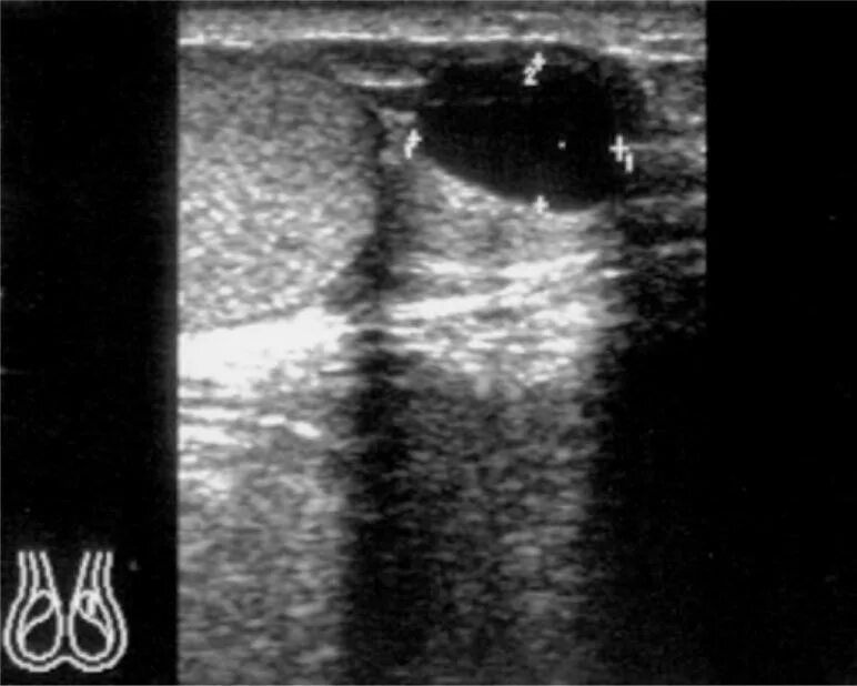 Киста семенного канатика на УЗИ. Киста придатка яичка на УЗИ. Водянка семенного канатика УЗИ. Семенной канатик УЗИ картина.