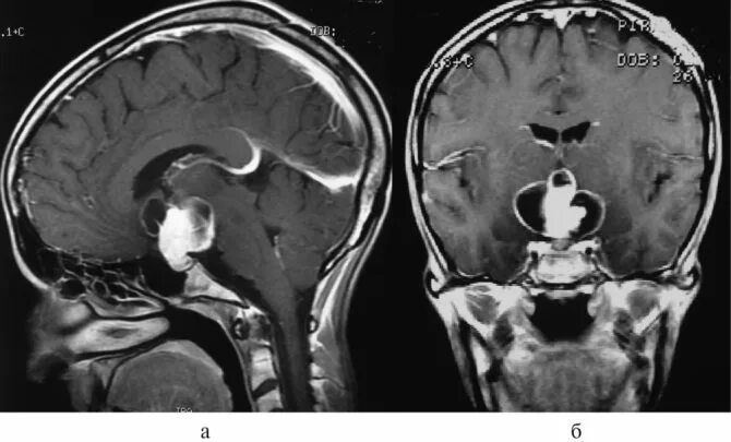 Адамантиноподобная краниофарингиома. Краниофарингиома гипофиза мрт. Краниофарингиома гипофиза кт.