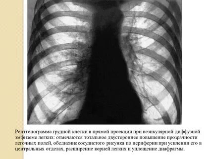 Грудная эмфизема