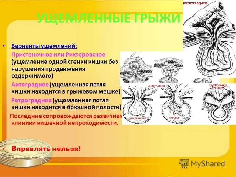 Рихтеровское ущемление грыжи. Рихтеровское ущемление грыжи. Пристеночное ущемление (грыжа рихтера). Пристеночное ущемление (грыжа рихтера). Рихтеровского ущемления грыжи.