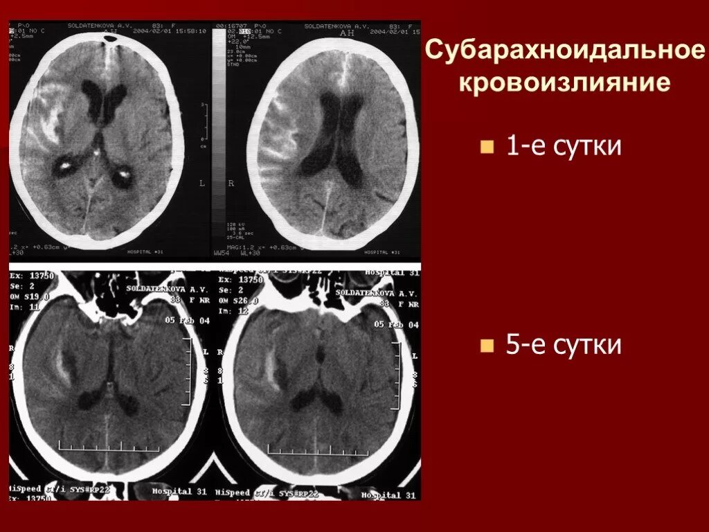 Субарахноидальное кровоизлияние головного мозга на кт. Геморрагический инсульт субарахноидальное кровоизлияние кт. Субарахноидальные кровоизлияния на мрт. Субарахноидальный инсульт кт. Травматическое кровоизлияние